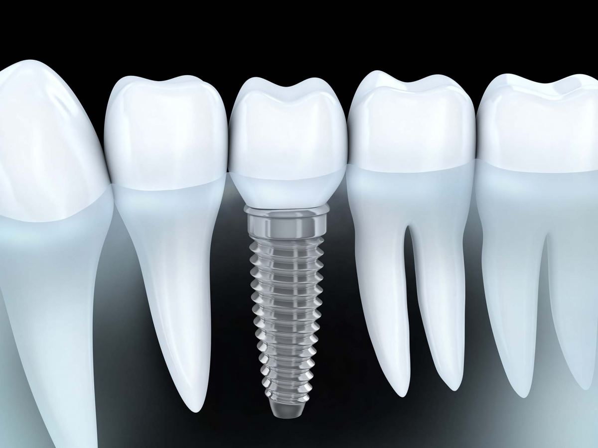 Dental Implants Blue Mountains