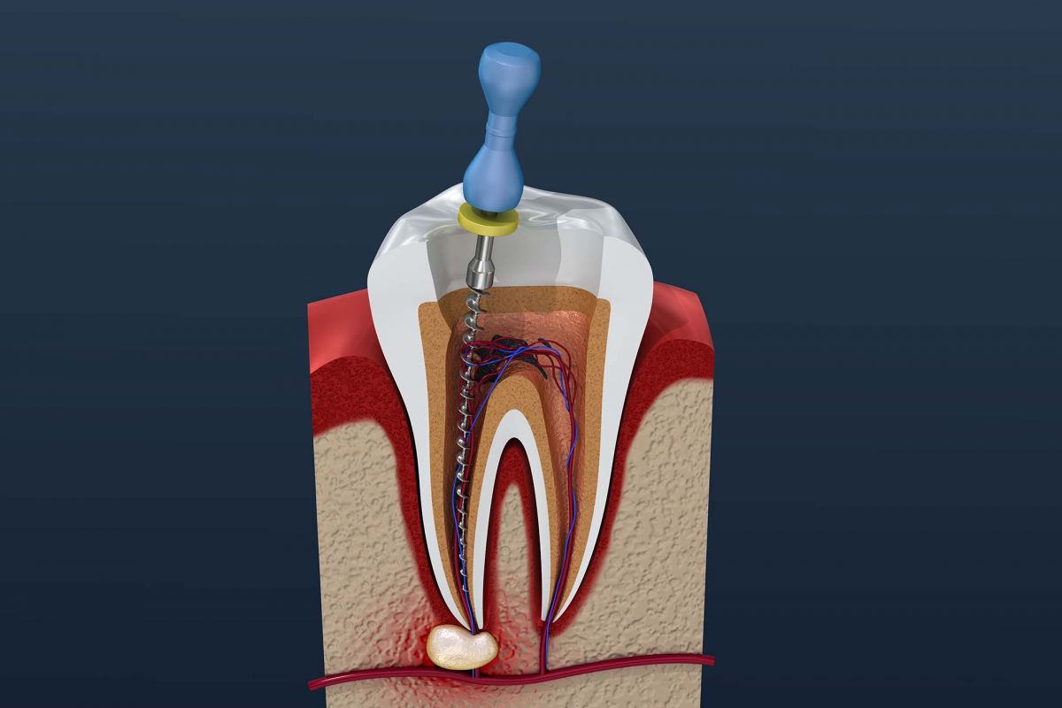 Root Canal Blue Mountains